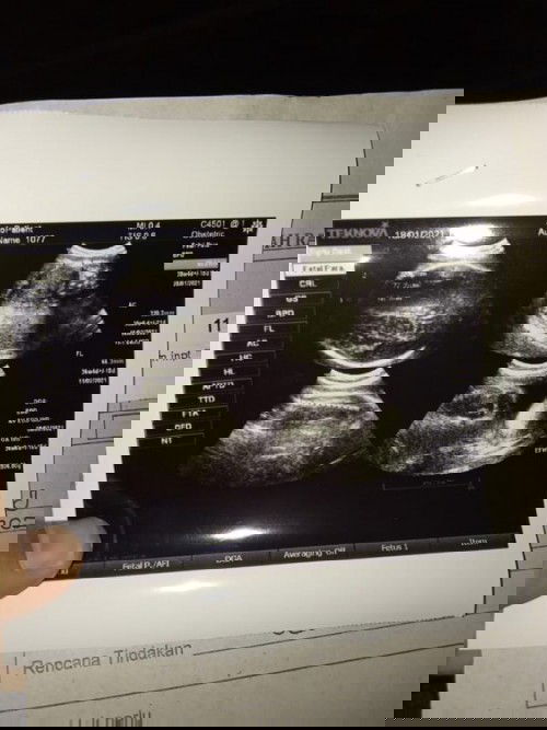 Bunda disini ada engga yang punya riwayat pinggul sempit tapi bisa lahiran normal .... 
Bingung bgt