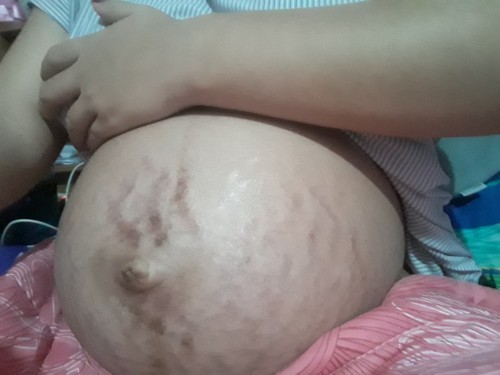 แม่ๆบ้านไหนมีวิธีแก้ท้องแตกลายบ้าง...แนะนำกันหน่อยน๊า..นี่ขนาดทาครีมแล้วก็ยังแตกลายอยู่เลย😥