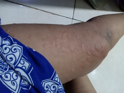 Obat alergi bahaya atau tidak?