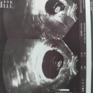 Can't feel baby movement