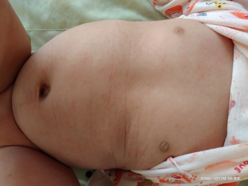 ผื่นแบบนี้เรียกว่าผื่นอิทรายหรือป่าวคะ