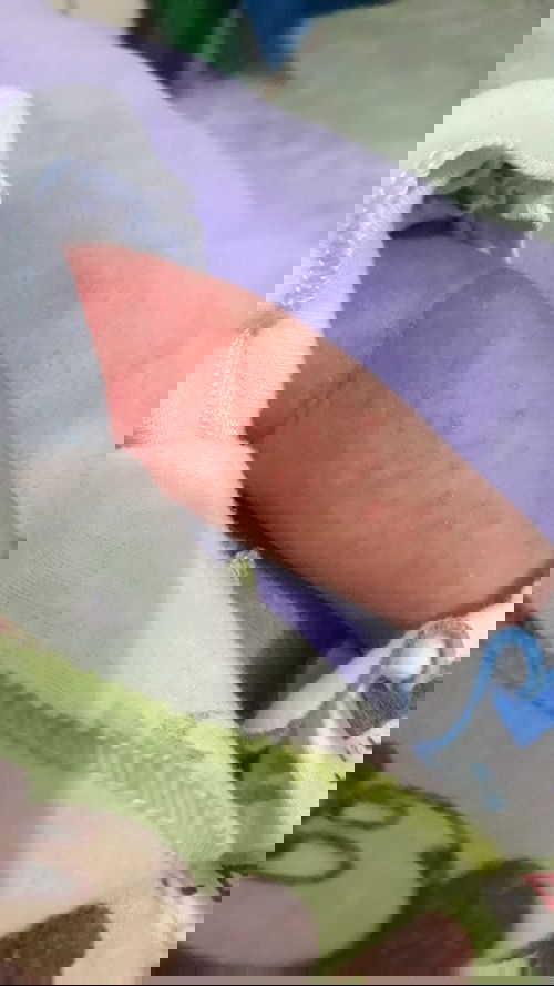 Bintik merah atau dalam bahasa Jawa namanya Byah (Biang keringat)