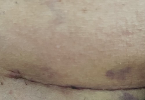 Csection scar