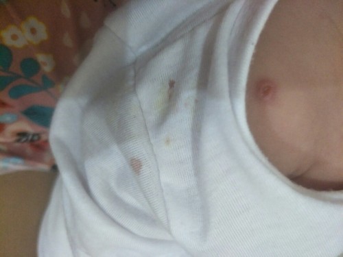 bakuna sa arm ni baby