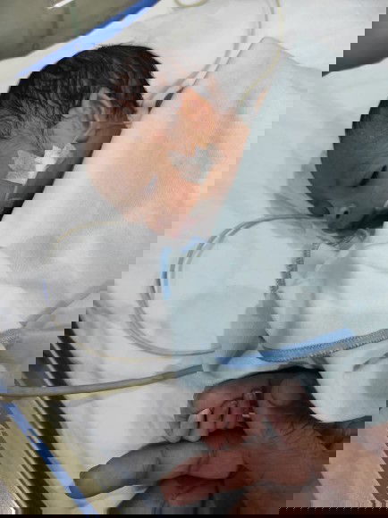 Pierre Robin syndrome (PRS)