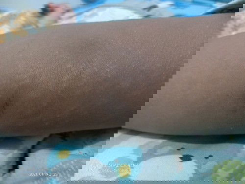 Brintik2 di tangan dan perut