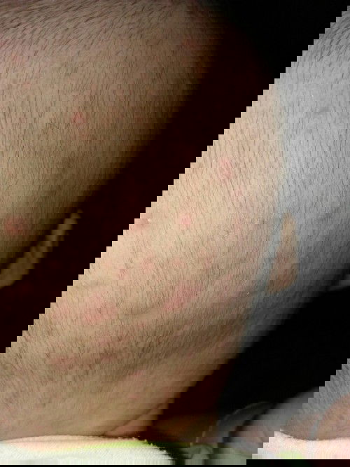 Assallamualaikum bun,bayiku bintik2 diarea kepala & leher kenapa ya bun,dan obatnya apa?