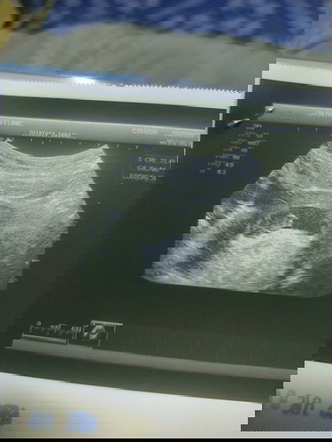 อัตราซาวด์ 8w เจอตัว แต่ไม่เห็นหัวใจเต้น