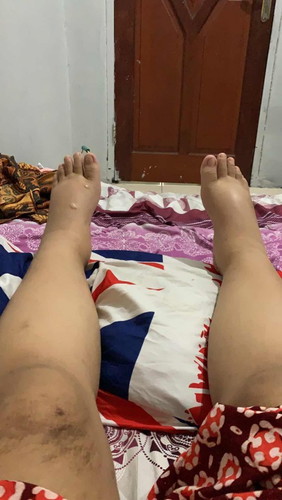 Kaki bengkak karna tensi tinggi dan urin positif 4