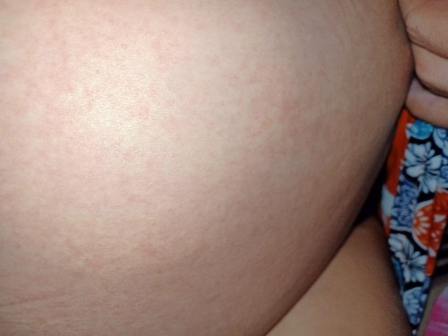 Sedang hamil 27week, gimana solusi untuk menghilangkan gatal pada permukaan kulit perut?