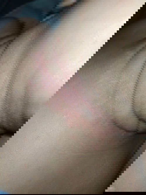 Ruam di leher, awalnya merah terus saya kasih Zwitsal cream setelah itu ganti kulit tapi gak rata😭