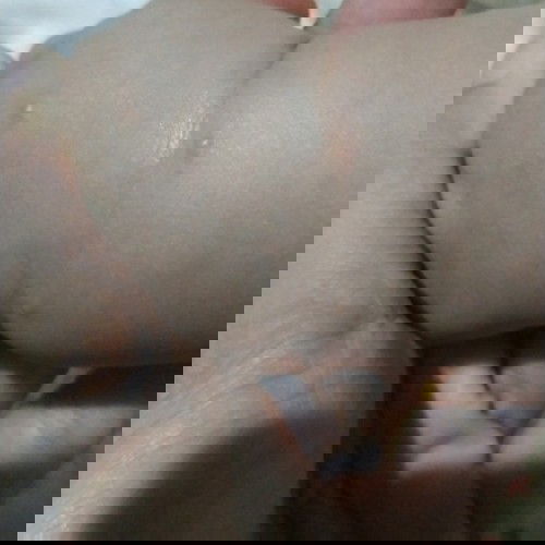 Bentol di tangan bayi