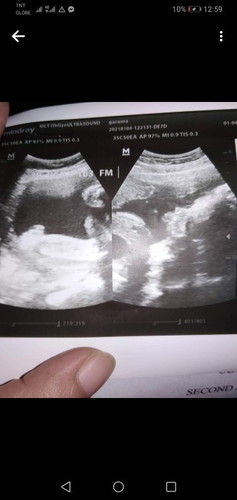 Ultrasound