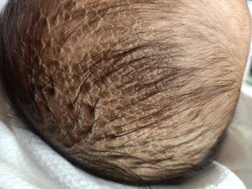 CRADLE CAP- ANONG PWEDE GAWIN PARA MAWALA ?