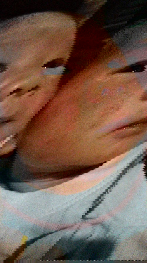 Biang keringan pada bayi 9 hari