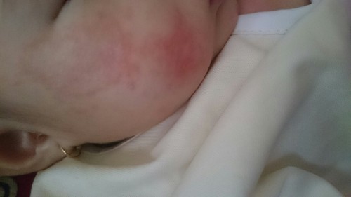 Bé 3 thág 15 ngày da mặt bị như vậy phải làm sao đây các mom