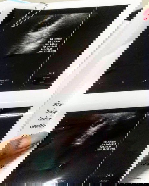 มีลิ้มเลือดออกจากช่องคลอดอยากสอบถามแม่ๆคะ