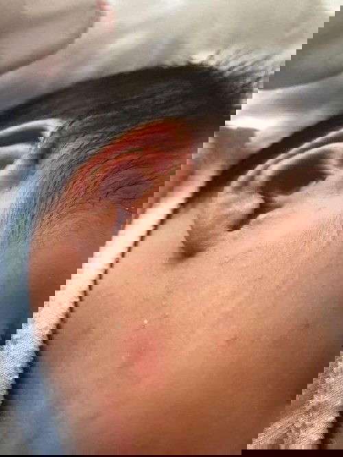 Da nổi đỏ trên mặt