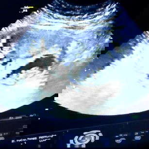 Sharing Kehamilan Kembar