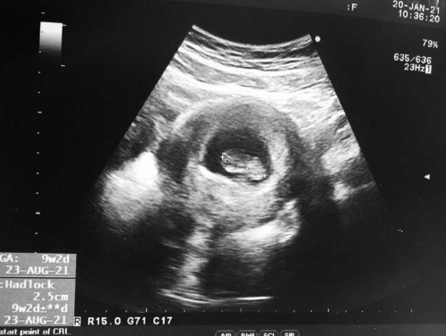 มีคุณแม่คนไหน 9 วีค