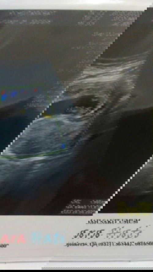 USG si bungsu UK 8mgu 4hr