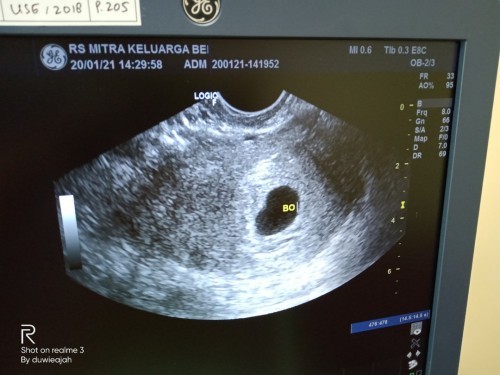 Bun sharing dunk ada gak yg pernah divonis hamil B.O diusia kehmilan 7week,,,tapi pas cek dokter lai