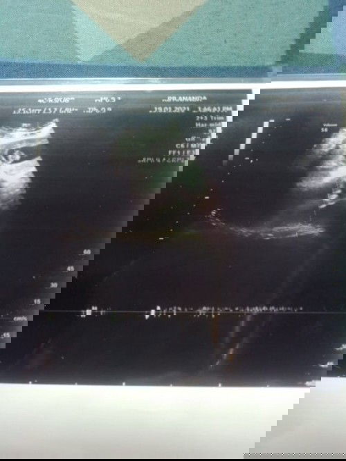 Usia kandunganku 10w 4d,