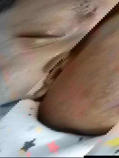 Anak sering muntah sehabis nyusui ASI dan pipi,leher dan kelopak matanya merah karna sering kena air susu gitu ?