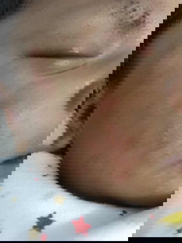 Anak sering muntah sehabis nyusui ASI dan pipi,leher dan kelopak matanya merah karna sering kena air susu gitu ?