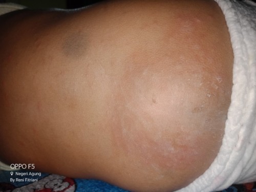 Keringat malam pada kulit bayi