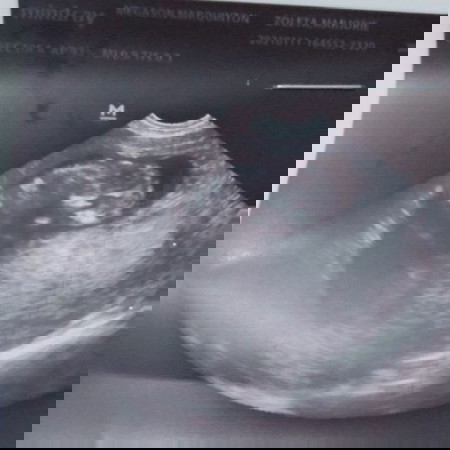 Baby ko ๐ 11weeks