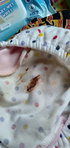 Flek Coklat dan Lendir di V bayi beberapa hari