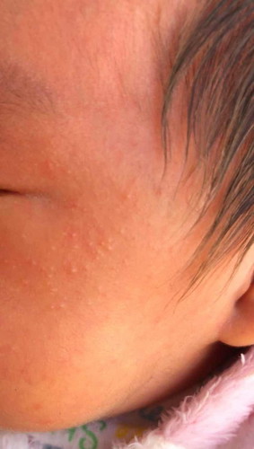 หน้าลูกผื่นขึ้น