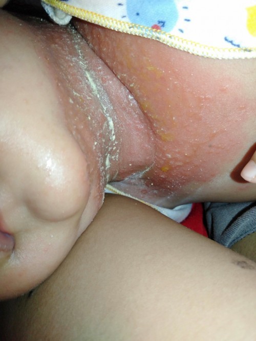Iritasi bayi