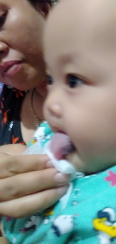 Sy mao tanya,anak saya sakit ada benjolan d bawah lidah,,,menurut dokter anak itu pembulu darah,,
