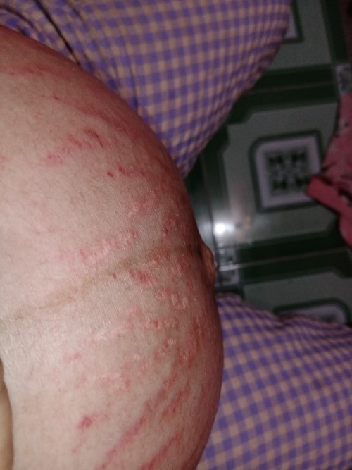 Trị rạn bụng