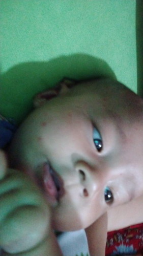 Bun mau tanya dong buat ngilangin bekas nyamuk pake apa ya bun?