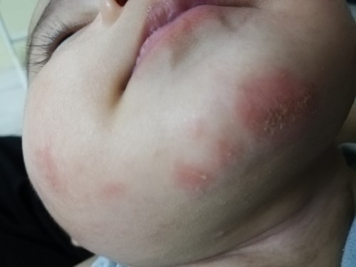 Eczema ke ni?