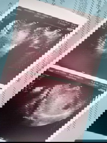 Transvaginal result