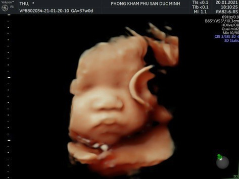 37w mà baby 3,4kg có tổ quá k các mom