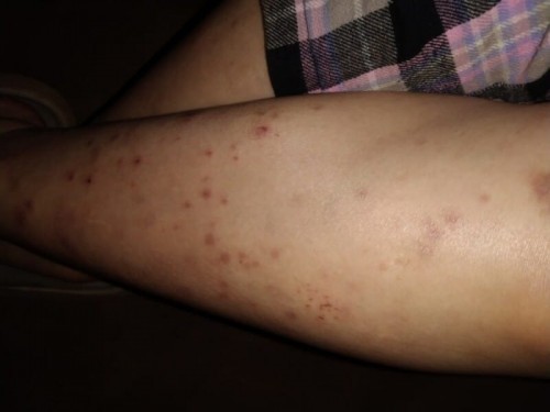 ท้องแขนขาลาย