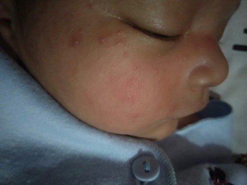 Tanya dong bun ini kenapa yaa bintik bintik pada kulit bayi tp cuma di muka saja