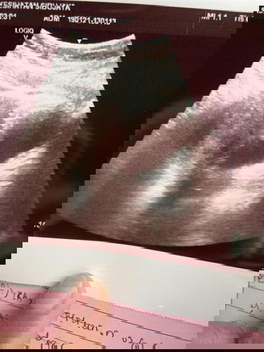 5 weeks baby scan but still cant see baby