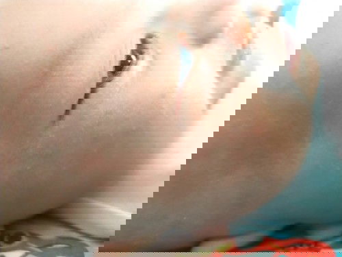 Gatal mrintis merah pd bayi