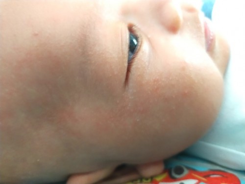 Gatal mrintis merah pd bayi