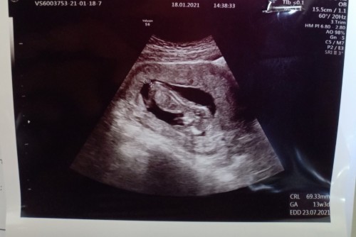 ซาวด์ 13 week น้องนอนคว่ำ ผิดปกติไหมคะ