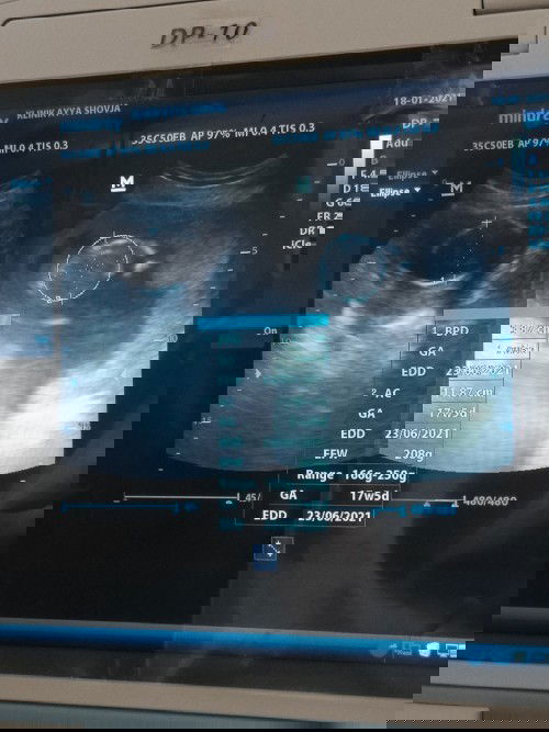 Tanya usia kandungan saya 18 minggu lebih 2 hari