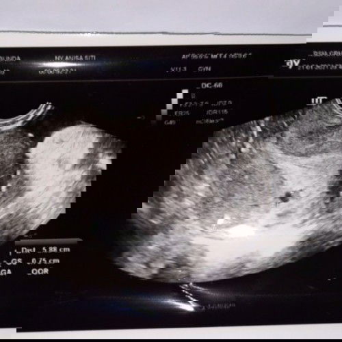 Hasi tespack negatif hasi usg trans v positif