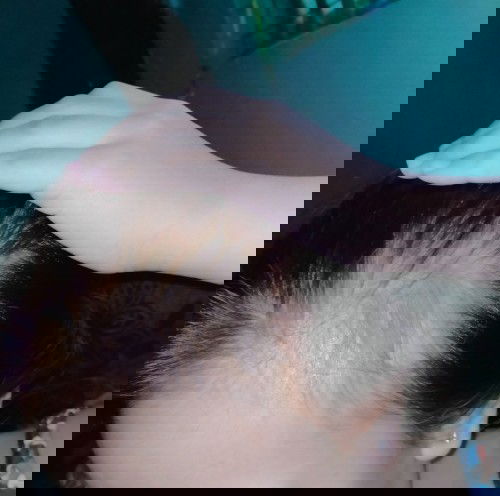 im having a pospartum hairfall😥