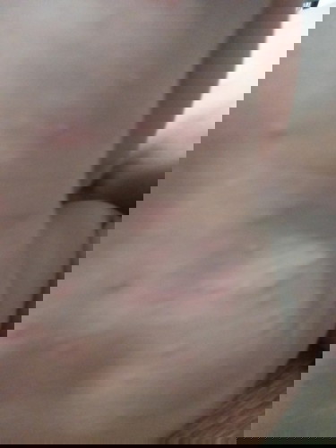 Bé bị vậy là bị gì vậy mấy mom? Nỗi hạt đầy người luôn ạ